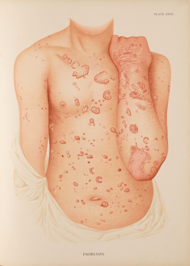Ein Buchumschlag mit einer Illustration eines Mannes mit roten Flecken, die wahrscheinlich Psoriasis darstellen, zusammen mit Text über die Erkrankung.