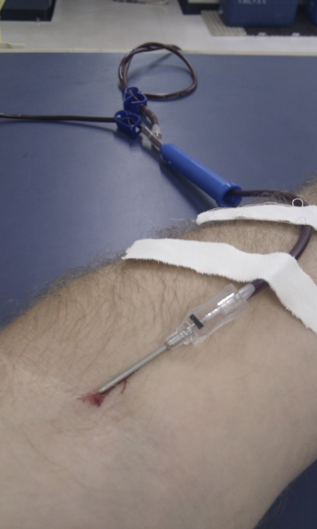 Eine Hand einer Person mit einem Salzlösungsschlauch und einer Nadel sowie mehreren Pflastern auf der Haut.